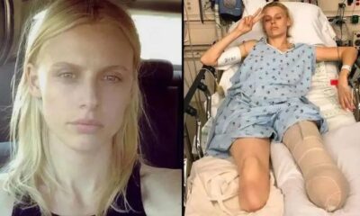 American model loses legs and almost dies despite proper tampon use! …Read more