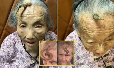 “This is too risky”: 107YO went viral because the 4-inch “Longevity Horn” growing on her forehead was said to be due to... see more