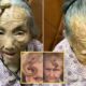 “This is too risky”: 107YO went viral because the 4-inch “Longevity Horn” growing on her forehead was said to be due to... see more