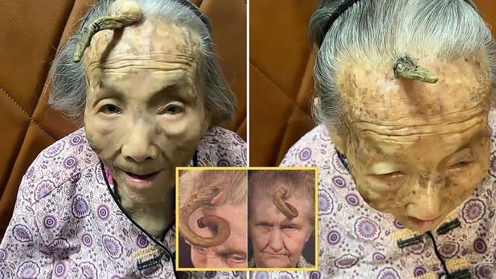 “This is too risky”: 107YO went viral because the 4-inch “Longevity Horn” growing on her forehead was said to be due to... see more